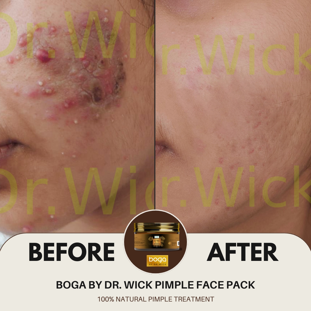 Doctor-Formulated Face Pack For Pimple Skin - Boga By Dr.Wick - Image 2