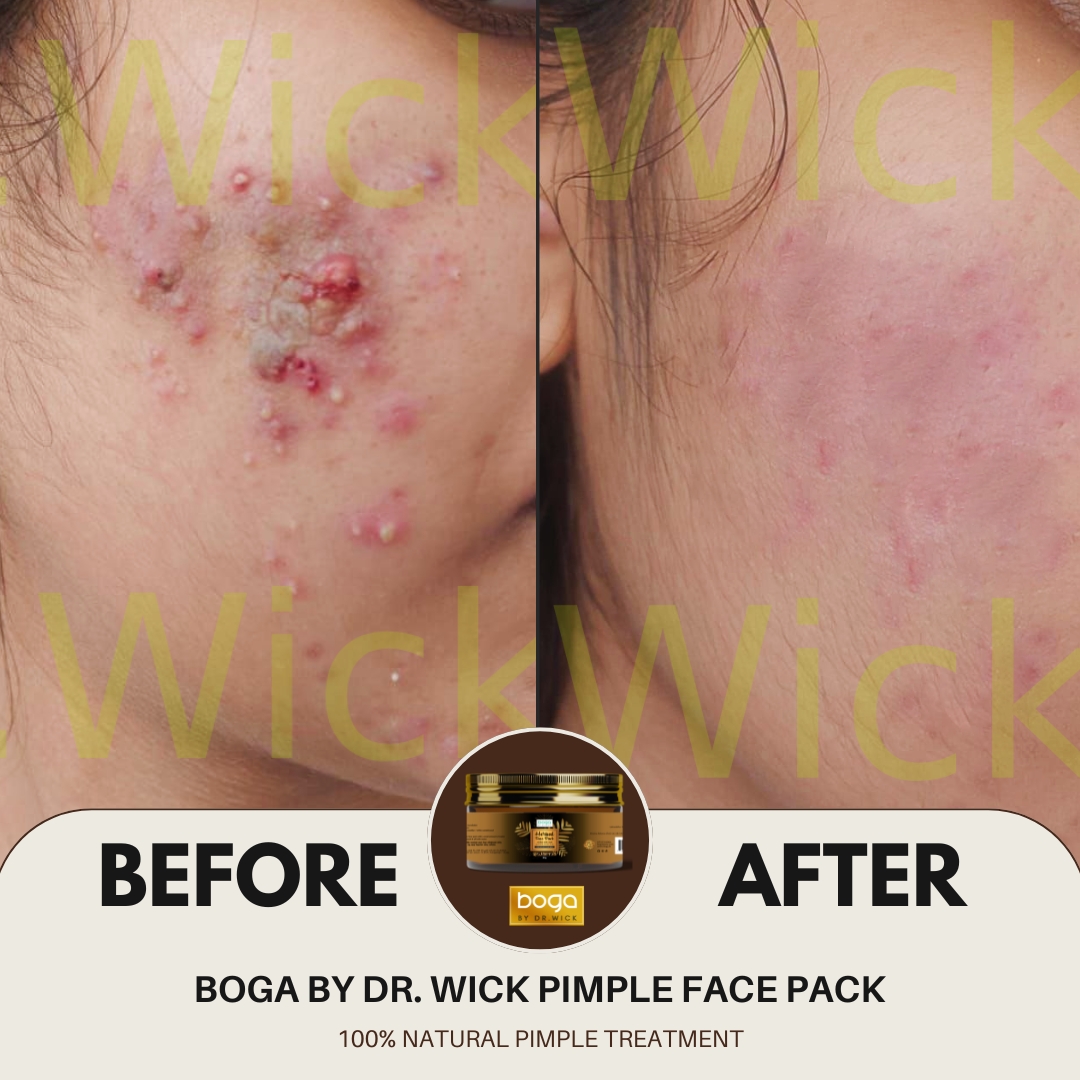 Doctor-Formulated Face Pack For Pimple Skin - Boga By Dr.Wick - Image 3