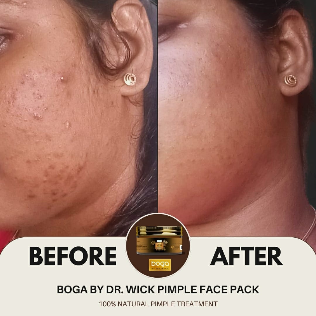 Doctor-Formulated Face Pack For Pimple Skin - Boga By Dr.Wick - Image 4